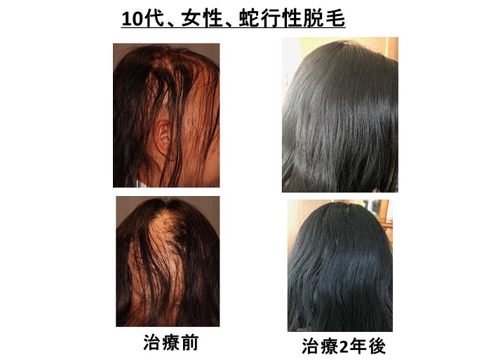 円形脱毛症　病院